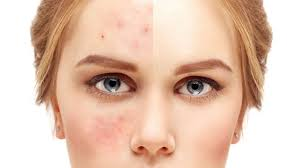 Connnect with skin care consultant in roorkee