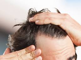Best Hair fall treatment in Roorkee