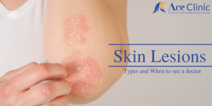 Its time to find best skin lesions doctors in roorkee