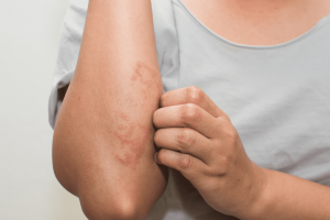 Eczema treated by Best dermatologist in roorkee - dr tanveer fatima