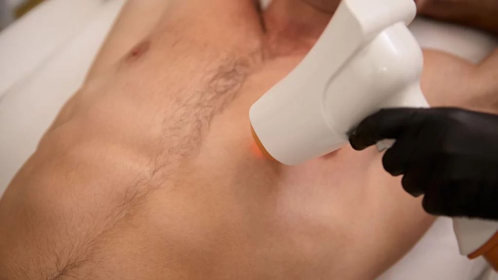 Laser Hair Removal in Roorkee