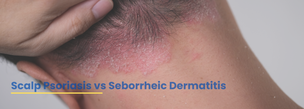 Scalp psoriasis vs seborrheic dermatitis visual comparison by hair specialist Dr. Tanveer Fatima at ACE Clinic, Roorkee.