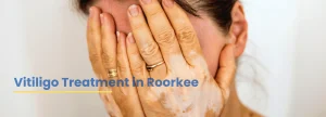 Vitiligo Treatment in Roorkee at ACE Clinic – advanced care for white patches