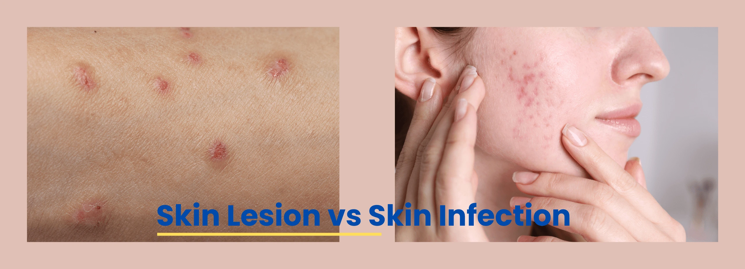 Skin Lessiom Skin Lesion vs Skin Infection - ACE Clinic