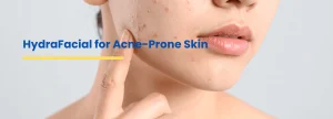 HydraFacial for acne-prone skin showing clogged pores and breakouts treated by Dr. Tanveer Fatima at Ace Skin Clinic