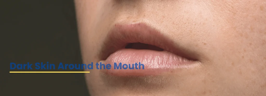 Close-up image showing dark skin around mouth, a common pigmentation issue explained and treated by Dr. Tanveer Fatima at ACE Clinic.