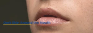 Close-up image showing dark skin around mouth, a common pigmentation issue explained and treated by Dr. Tanveer Fatima at ACE Clinic.