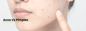 Acne vs pimples explained by Dr. Tanveer Fatima at ACE Skin and Hair Clinic, Roorkee, showing the difference between acne and pimples and the right treatment.